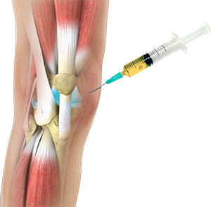 تزریق PRP||||درد مزمن1
